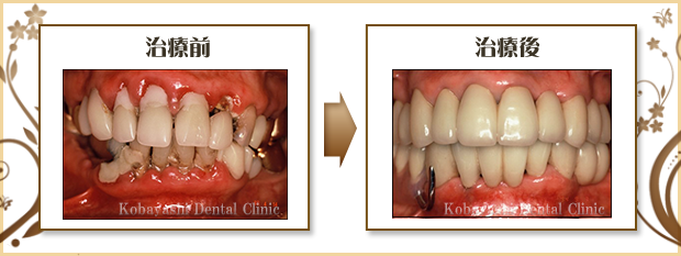 歯周病治療 | 本厚木の歯医者 | 小林歯科医院