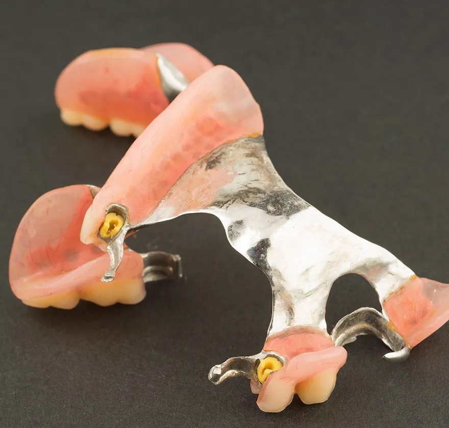 歯冠外アタッチメントbg