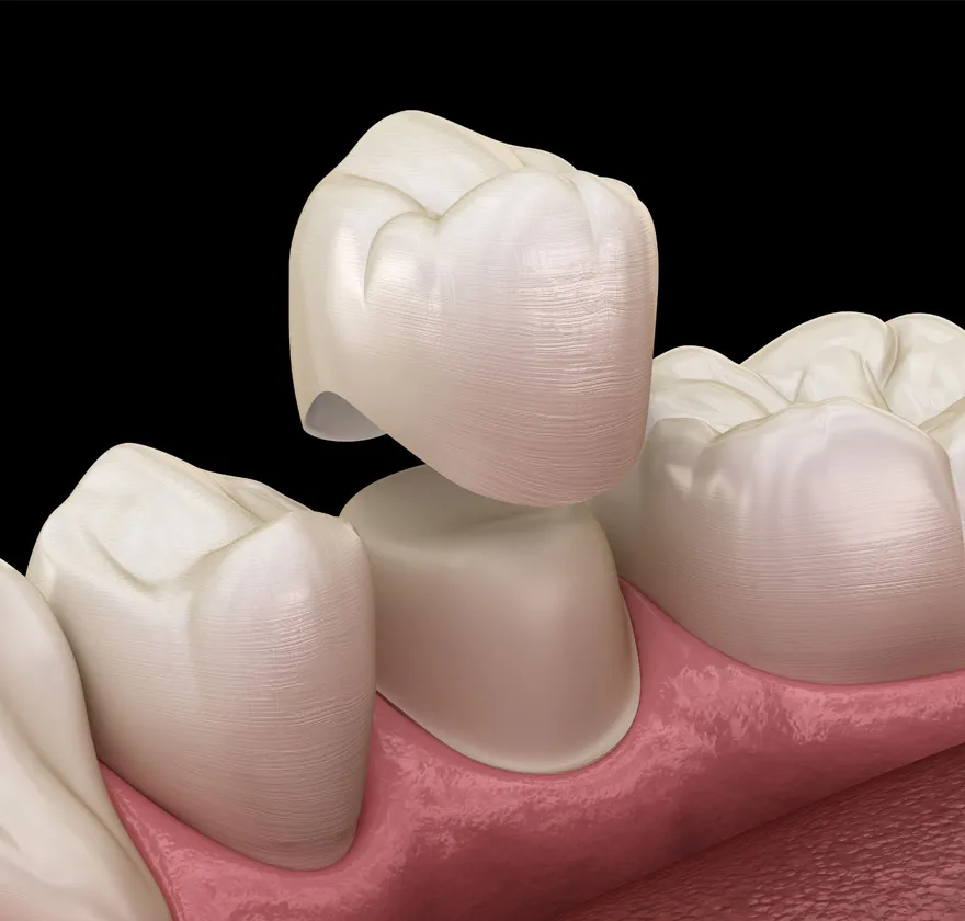 セラミッククラウンbg