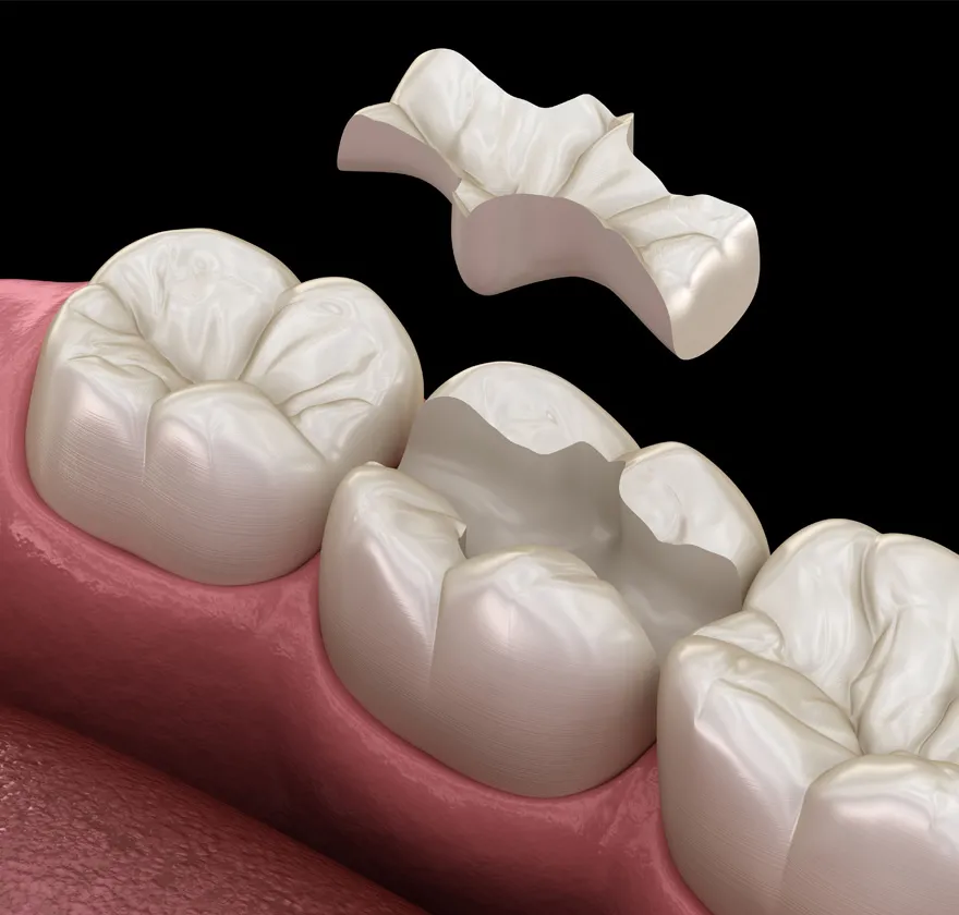 セラミック（ポーセレン）インレーbg