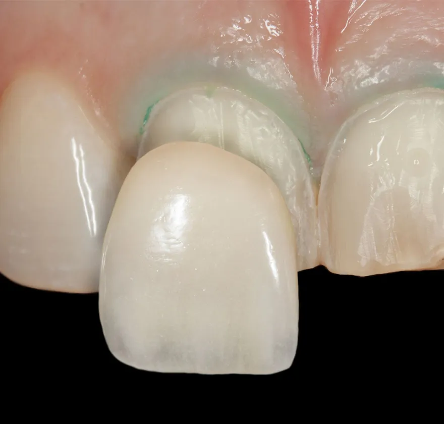 ラミネートベニアbg