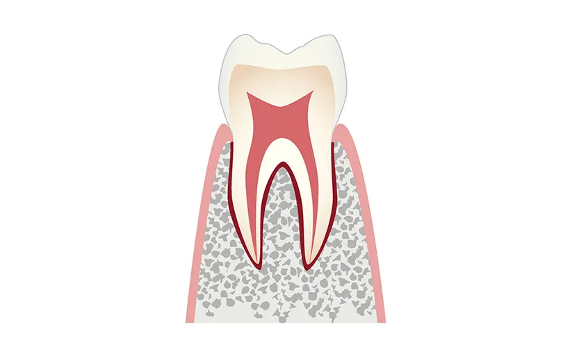 CO（Caries Observation＝要観察歯）