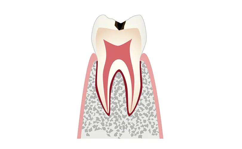 C1（エナメル質の虫歯）