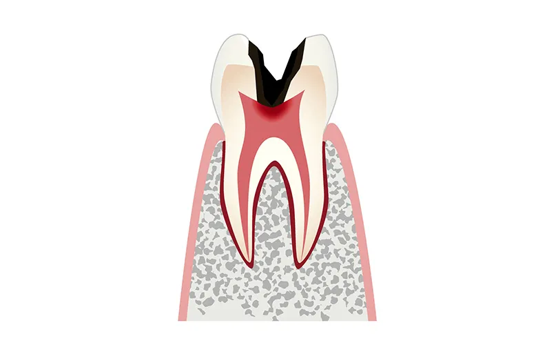 C3（神経まで進行した虫歯）