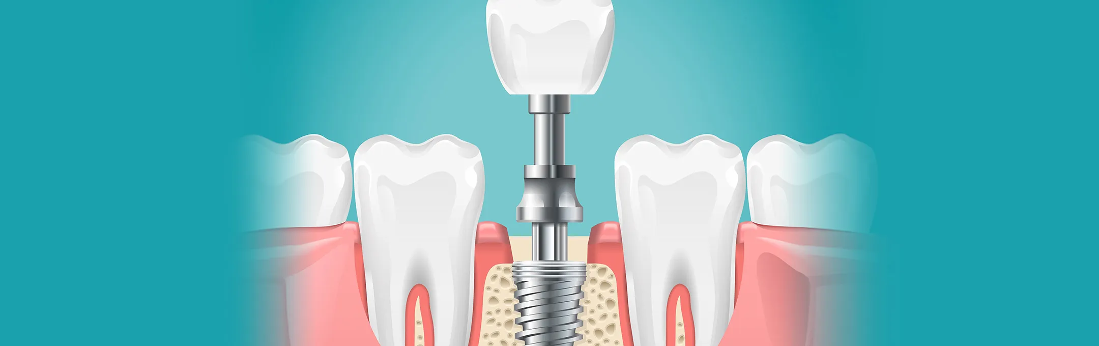 インプラント治療とは─失った歯を補う方法はいろいろあります─