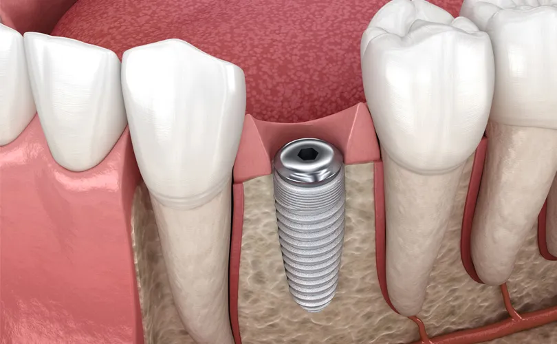 インプラント手術(1次手術)