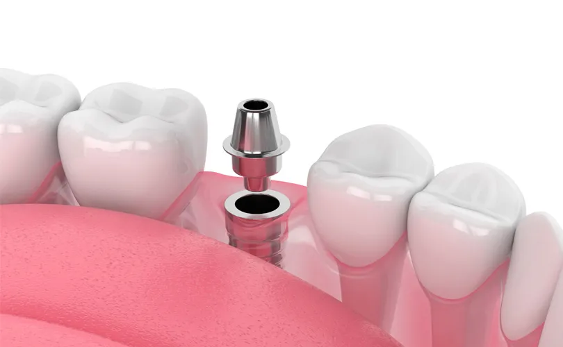 インプラント手術(2次手術)