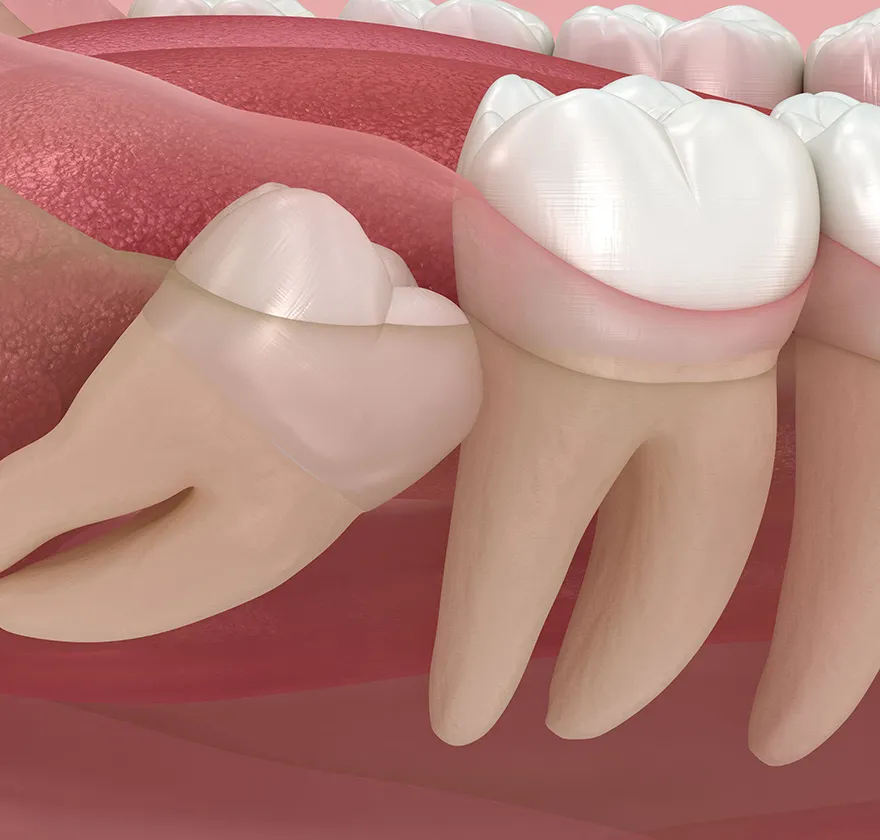 親知らずの抜歯